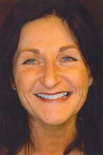 GlamSmile veneers - after