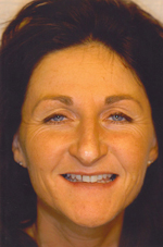 GlamSmile veneers - before