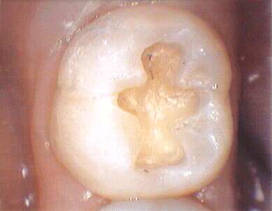 amalgam tooth preparation