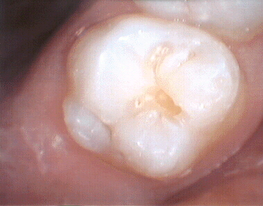 composite tooth preparation