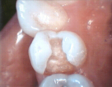photo amalgam proximal tooth preparation