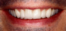 porcelain crowns