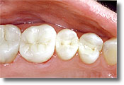amalgam fillings replaced with composite fillings