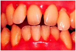 Bleeding gums