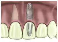 implant.jpg (7319 bytes)