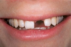 Missing front teeth can be replaced with dental implants.