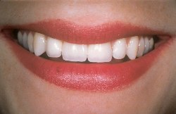 Dental implant replacing missing tooth.