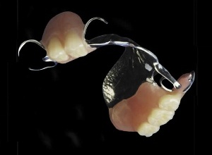 removable partial denture