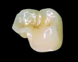 Porcelain onlay