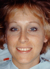 Picture before porcelain veneers