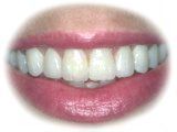 Photograph after porcelain veneers.