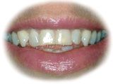 Photograph before porcelain veneers.