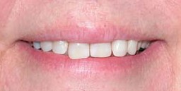 teeth effects
