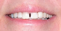 teeth effects before