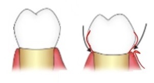 line drawings showing two crowns. The overcontoured crown promotes food collecting.