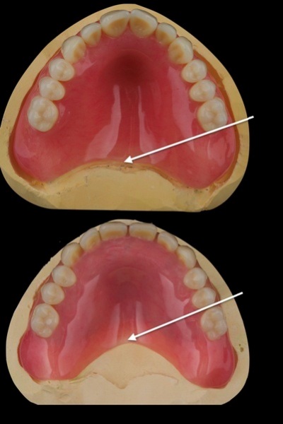 A photo of two dentures on plaster casts, one extended to the vibrating line and one cut to be short of that line
