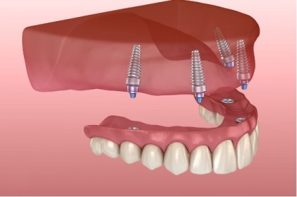 drawing of an upper jaw with four implants embedded in the jawbone, and replacement teeth positioned ready to be fastened to them