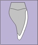 a drawing showing a thin porcelain veneer over the front of an upper incisor tooth