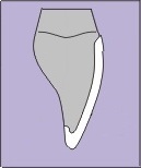 drawing of a thin porcelain veneer over an upper incisor tooth, showing a slight overhang where the veneer doesn't meet the tooth smoothly
